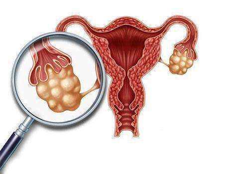 “卵巢囊肿”的归宿